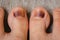Feet on the floor. Damaged nails. Bruise under thumb nail. Barefoot close up. Nail illness. Health treatment. Foot care concept.