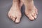 Feet Of Woman Deformed From Rheumatoid Arthritis
