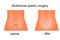 Female abdomen before and after abdominoplasty