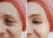 Female adult facial wrinkles treatment mature patient difference before and after cosmetic procedures, arrow