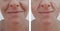 Female adult wrinkles removal dermatology contrast lift filler patient difference before and after procedures, arrow