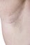 Female Armpit With Irritation
