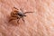 Female castor bean tick crawling on pink human skin. Ixodes ricinus