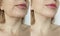 Female double chin  tension  before and after correction