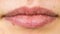 Female dry lips with herpes cold sore