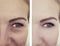 Female eye wrinkles before  after cosmetology procedures