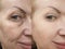 Female face problem wrinkles before and after lifting procedure rejuvenation treatment collage
