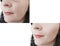 Female face wrinkles collage mature lifting dermatology beautician before and after procedures therapy