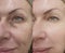 Female face wrinkles before and after  rejuvenation  treatment collage