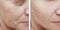 Female facial wrinkles before and after procedures