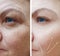 Female facial wrinkles before and after procedures arrow