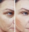 Female facial wrinkles before and after removal procedures arrow