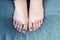 Female feet with `subungual hematoma`, black toenails caused by trauma after watking 30 miles.