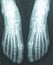 female feet xray radiograph