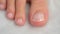 Female foot with damaged nail, fungus disease