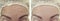 Female forehead wrinkles before after procedures therapy