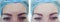 Female forehead wrinkles results aging correction therapy before and after treatments