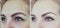 Female forehead wrinkles results collage tension aging therapy before and after treatments