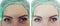 Female forehead wrinkles results correction therapy before and after treatments