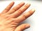 Female hand with dry atopic skin. White background. Close-up of the skin on the hands and fingers. Derma in need of care and