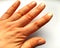 Female hand with dry atopic skin. White background. Close-up of the skin on the hands and fingers. Derma in need of care and