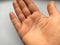 Female hand with dry atopic skin. White background. Close-up of the skin on the palm and fingers. Derma in need of care and
