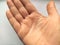 Female hand with dry atopic skin. White background. Close-up of the skin on the palm and fingers. Derma in need of care and