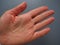 Female hand with dry atopic skin. White background. Close-up of the skin on the palm and fingers. Dermatological