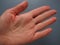 Female hand with dry atopic skin. White background. Close-up of the skin on the palm and fingers. Dermatological