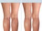 Female healthy leg and the affected varicose veins