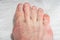 Female legs with natural broken nails. Female legs with crooked toes and bunion. Foot care concept