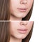 Female lips before and after augmentation