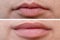 Female lips before and after augmentation, the result of using hyaluronic filler