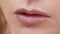 Female lips with bruise. close-up. effects of hyaluronic acid. lip augmentation