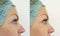 Female nose hump correctionblem, before and after before after procedures