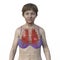 A female patient with lungs affected by miliary tuberculosis, 3D illustration