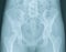 Female Pelvis X-Ray