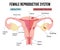 Female reproductive system, endometriosis.Scheme of gynecological diseases of the uterus.The state of growth of external tissues w