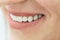 Female teeth macro zirconium. Closeup smile photo with zirconium artificial teeth. Zirconia bridge with porcelain