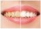 The female teeth before and after whitening.