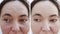 Female wrinkles before and after correction procedures