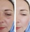 Female  wrinkles before  after  lifting correction procedures