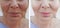 Female wrinkles before after treatment hydrating results therapy effect correction procedureremoval s