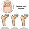 Femoral neck fractures medical  illustration on white background