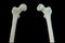 Femur bone affected by Legg-Calve-Perthes Disease, a childhood hip disorder, 3D illustration