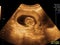 Fetus Sonogram