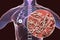 Fibrous-cavernous pulmonary tuberculosis
