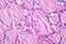 Fibrous thyroiditis, light micrograph