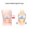 Fibular collateral ligament injury. joint anatomy