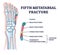 Fifth metatarsal or foot little finger fracture after injury outline diagram